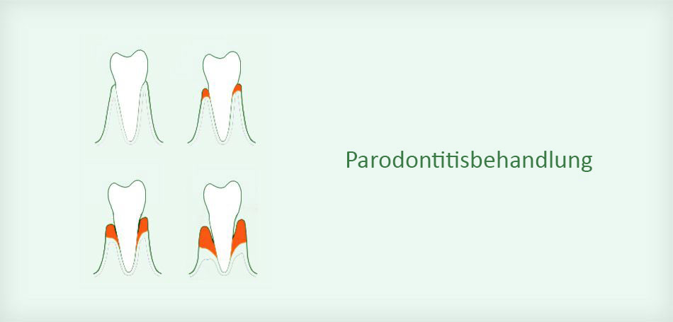 Parodontitsbehandlung